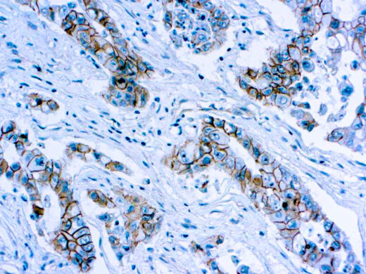 Formalin fixed paraffin embedded human lung carcinoma stained with Catenin β