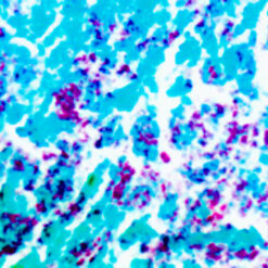 Acid Fast Bacilli Lung infected with Acid Fast Bacteria (A.F.B) (KT001)