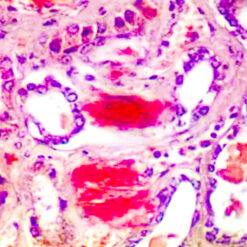 Amyloidosis in Kidney stained with AMY-1 Kit (KT008).