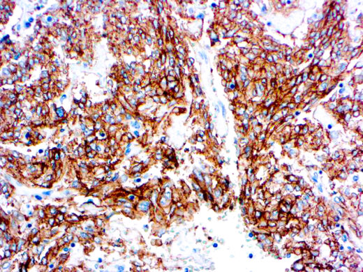 Formalin fixed paraffin embedded human gastrointestinal stromal tumor stained with CD117/c-Kit antibody.