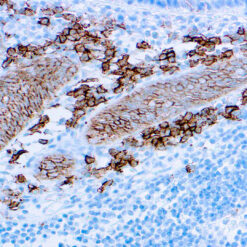 Formalin fixed paraffin embedded human tonsil tissue stained with CD138