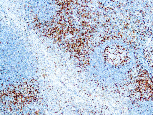 Formalin fixed paraffin embedded human tonsil stained with CD45RO antibody.