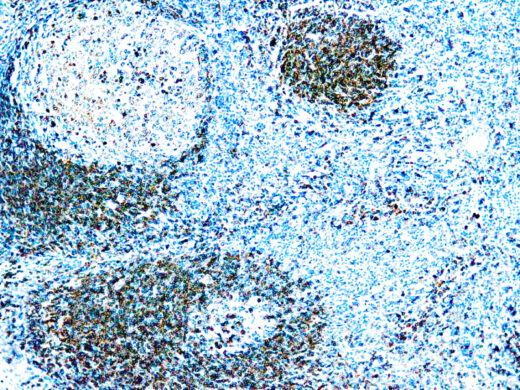 Formalin fixed paraffin embedded human tonsil stained with CD79a Antigen.