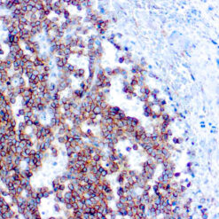Formalin fixed paraffin embedded human Ewing’s sarcoma stained with CD99.