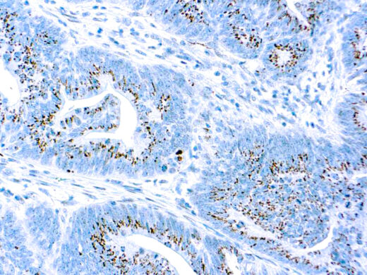 Formalin fixed paraffin embedded human Adeno Colon Ca stained with Caspase 3/CPP32