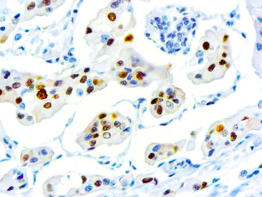 Formalin fixed paraffin embedded human Breast Carcinoma stained with Cyclin D1.