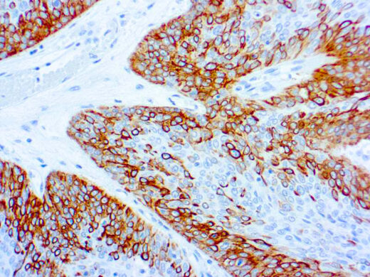 Formalin fixed paraffin embedded lung squamous cell carcinoma stained with Cytokeratin 14 antibody
