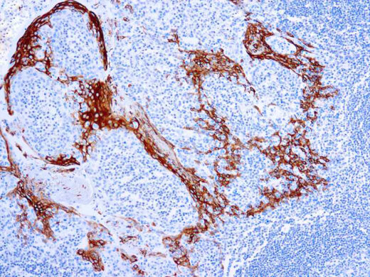 Formalin fixed paraffin embedded human tonsil stained with Cytokeratin 16 antibody