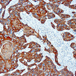 Formalin fixed paraffin embedded human Squamous Lung Carcinoma stained with Cytokeratin antibody