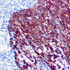 Formalin fixed paraffin embedded human colon adenocarcinoma stained with Cytokeratin, Pan antibody
