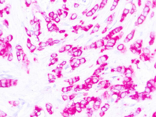 Formalin fixed paraffin embedded human breast carcinoma stained with Epithelial Antigen.