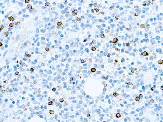 Formalin fixed paraffin embedded human infected tissue stained with EBV.