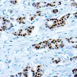 Formalin fixed paraffin embedded human breast carcinoma stained with Estrogen Receptor antibody.