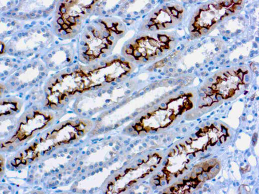 Formalin fixed paraffin embedded renal cell carcinoma stained with Ezrin antibody.