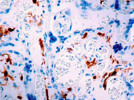 Formalin fixed paraffin embedded human placenta stained with Factor XIII-A antibody