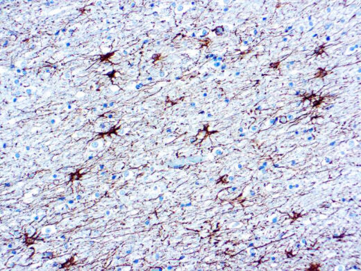 Formalin fixed paraffin embedded human brain stained with GFAP antibody