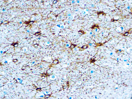 Formalin fixed paraffin embedded human brain stained with GFAP antibody.