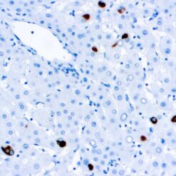 Formalin fixed paraffin embedded human liver stained with Hepatitus B Surface Antigen.
