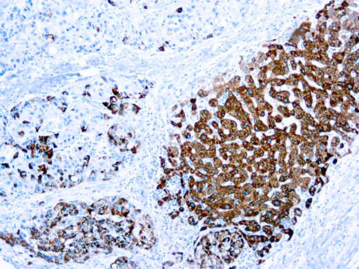 Formalin fixed paraffin embedded liver stained with Hepatocyte Specific Antigen antibody.
