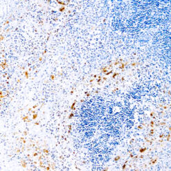 Formalin fixed paraffin embedded human infected tissue stained with Herpes Simplex Visus Type I and Type II antibody.