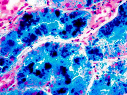 Iron Deposits in Liver Stained with Iron Stain (KT021).