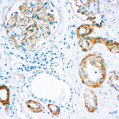 Formalin fixed paraffin embedded renal carcinoma stained with Laminin antibody.