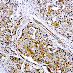 Formalin fixed paraffin embedded human breast carcinoma stained with MMP-9 antibody