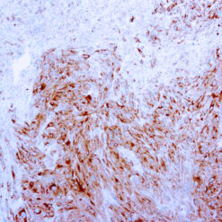 Formalin fixed paraffin embedded human melanoma stained with MART-1 antibody.