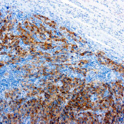 Formalin fixed paraffin embedded human melanoma stained with Melanoma antibody.