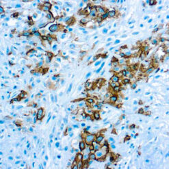 Formalin fixed paraffin embedded human mesothelioma stained with Mesothelioma antibody.