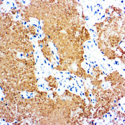 Formalin fixed paraffin embedded human infected tissue stained with Pneumocystis carinii antibody.