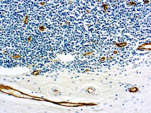 Formalin fixed paraffin embedded human tonsil stained with Factor VIII antibody.