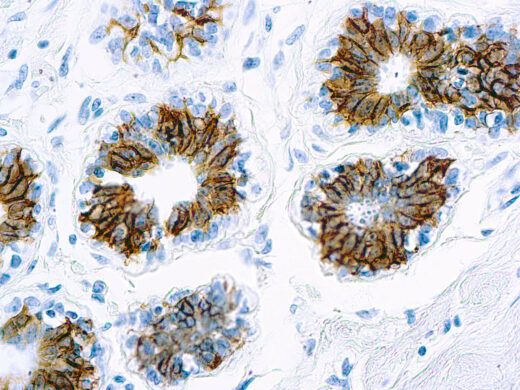 Formalin fixed paraffin embedded human breast carcinoma stained with Epithelial Antigen.