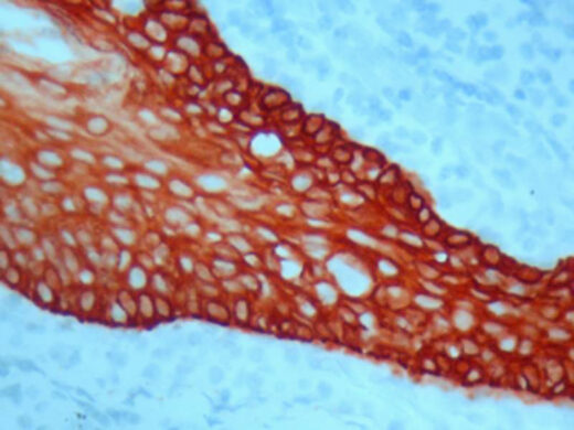 Formalin fixed paraffin embedded human tonsil stained with high molecular weight Cytokeratin H.M.W and labeled with Mono AEC/ Plus (K050).