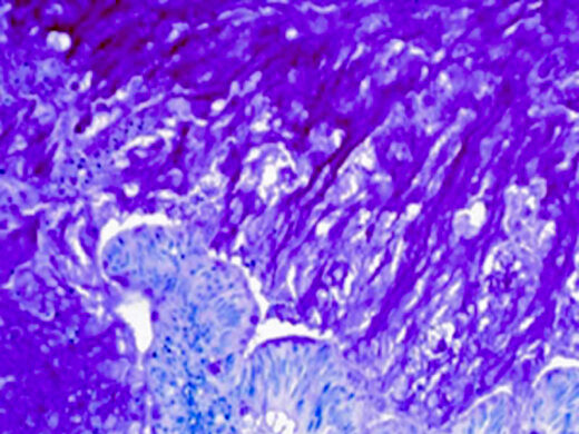 Human colon tumor stained with Mucicarmine kit (KT024).