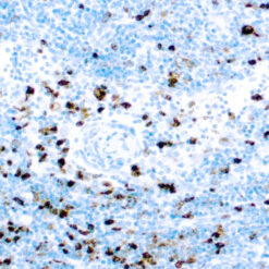 Formalin fixed paraffin embedded human lymphoma stained with Myeloperoxidase antibody.