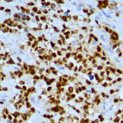 Formalin fixed paraffin embedded human rhabdomyoscarcoma stained with Myogenin.