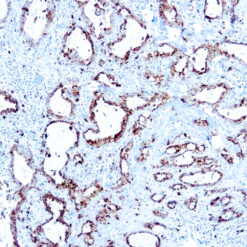 Formalin fixed paraffin embedded lung adenocarcinoma stained with Napsin A.