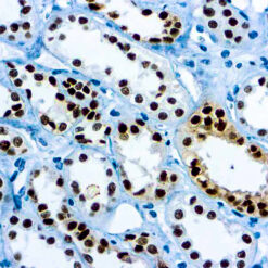 Formalin fixed paraffin embedded renal cell carcinoma stained with Pax-8 antibody.