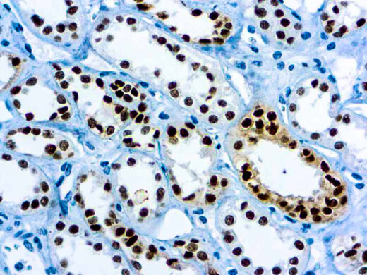 Formalin fixed paraffin embedded renal cell carcinoma stained with Pax-8 antibody.