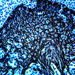Formalin fixed paraffin embedded human adenocarcinoma stained with Cytokeratin H.M.W and labeled with PermaBlack/HRP(K062).