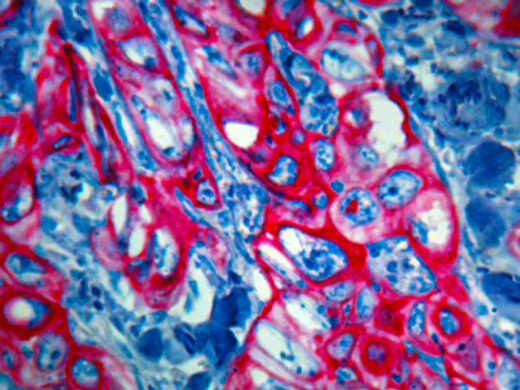 Formalin fixed paraffin embedded squamous cell carcinoma human tissue stained with CK 5/6 antibody (Mob362) labeled with PermaRed AutoPlus (K057) produces a brilliant red color.