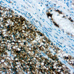 Formalin fixed paraffin embedded Seminoma stained with Placental Alkaline Phosphatase (PLAP) (SP15).