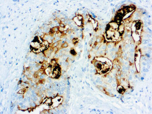 Formalin fixed paraffin embedded human Prostate carcinoma stained with PSMA