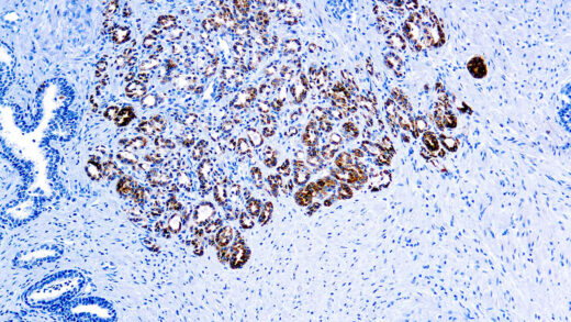 Formalin fixed paraffin embedded human prostate carcinoma stained with .