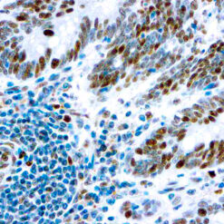 Formalin fixed paraffin embedded human colon carcinoma stained with Retinoblastoma antibody.