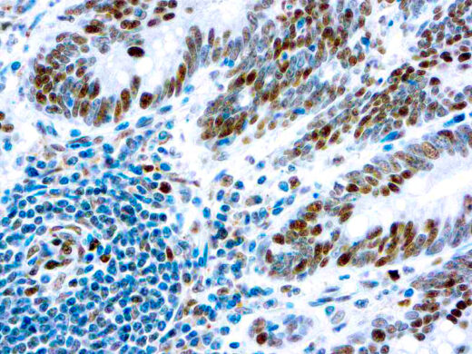 Formalin fixed paraffin embedded human colon carcinoma stained with Retinoblastoma antibody.