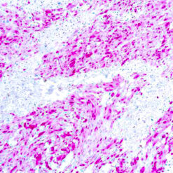 Formalin fixed paraffin embedded human melanoma stained with S-100 antibody.