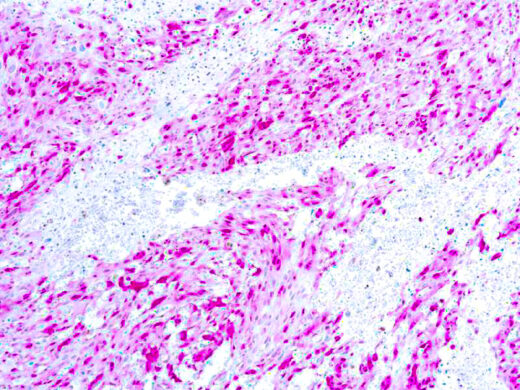 Formalin fixed paraffin embedded human melanoma stained with S-100 antibody.