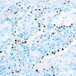 Formalin fixed paraffin embedded lung adenocarcinoma stained with TTF-1.